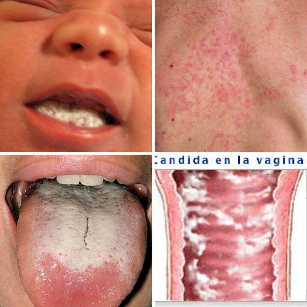 Como saber si tengo Candidiasis, [Cuestionario] - Herbolario Larrea
